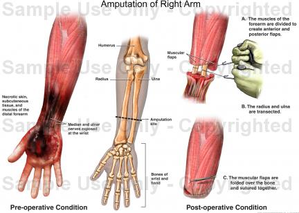 Arm and Hand Amputations